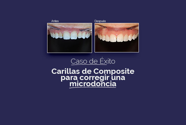 Carillas de Composite en Palencia para corregir una microdoncia: caso de éxito