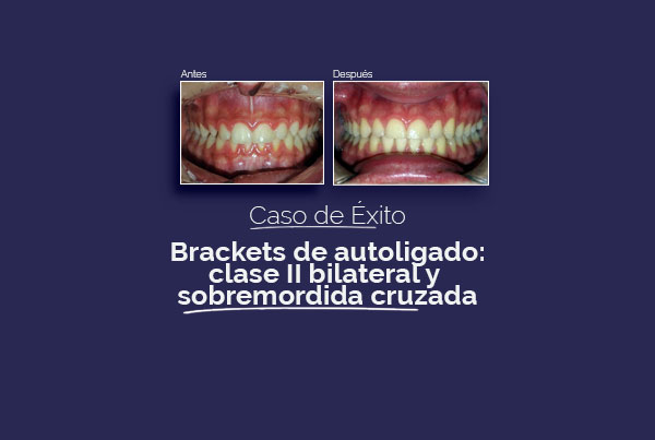Brackets de autoligado en Palencia para corregir una sobremordida