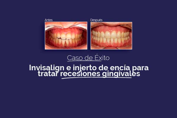 Invisalign e injerto de encía en Palencia para corregir recesiones gingivales