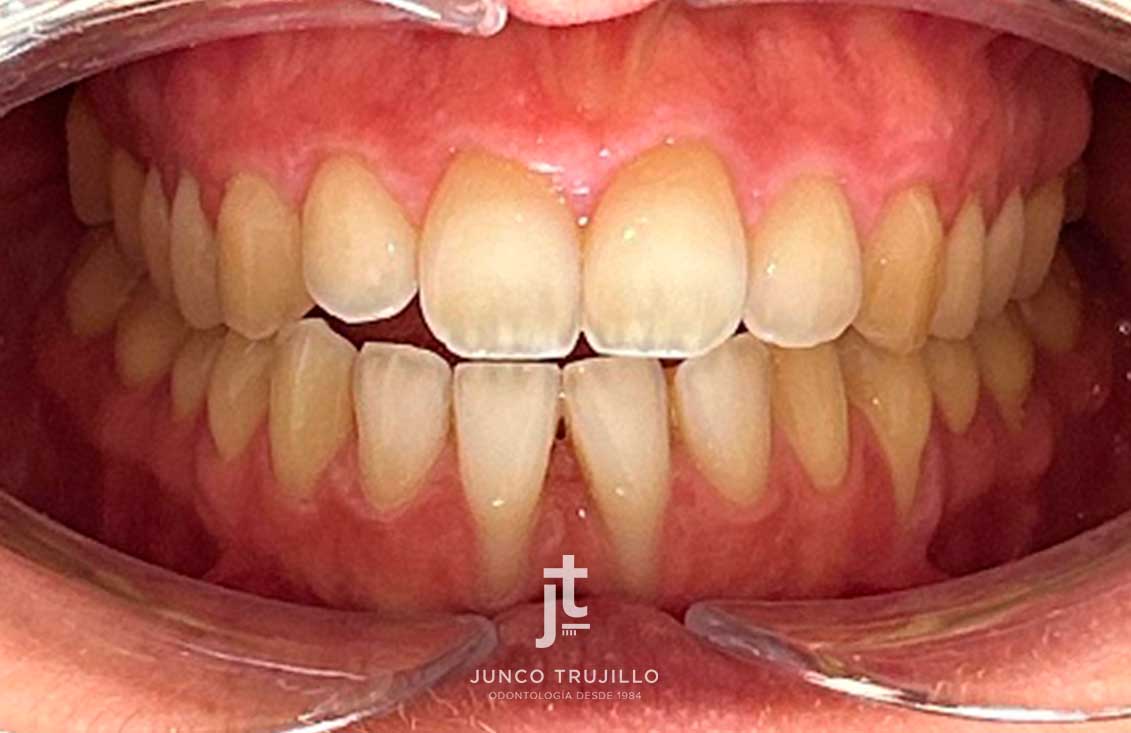 recesiones-gingivales-1