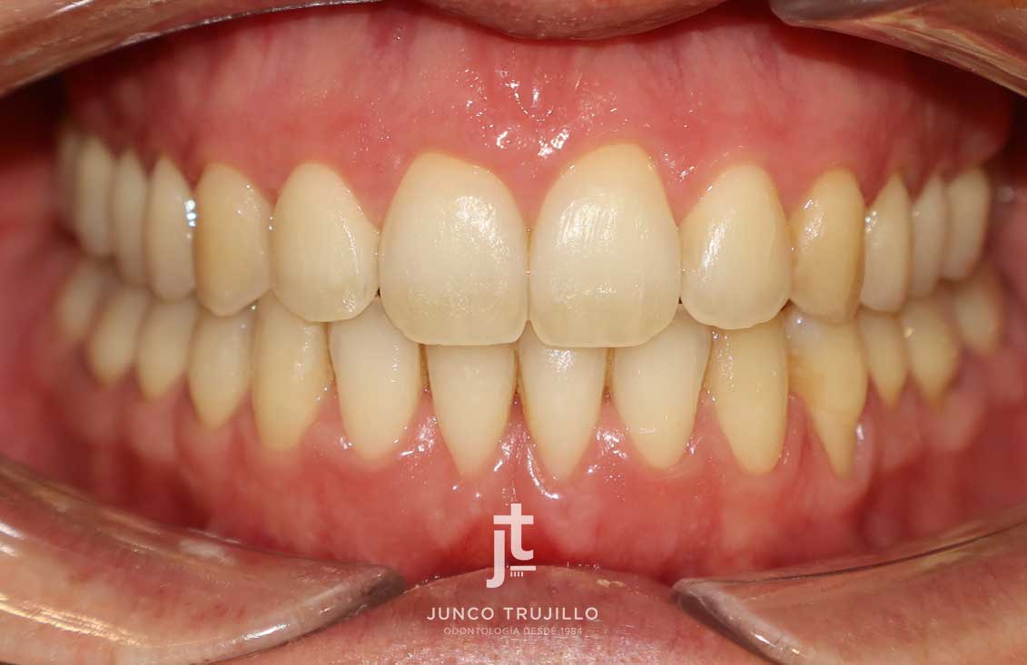 recesiones-gingivales-2
